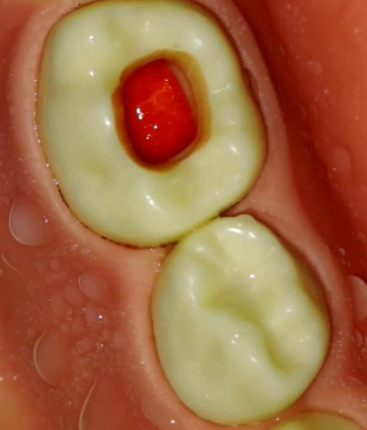 Deciduous Pulpotomy